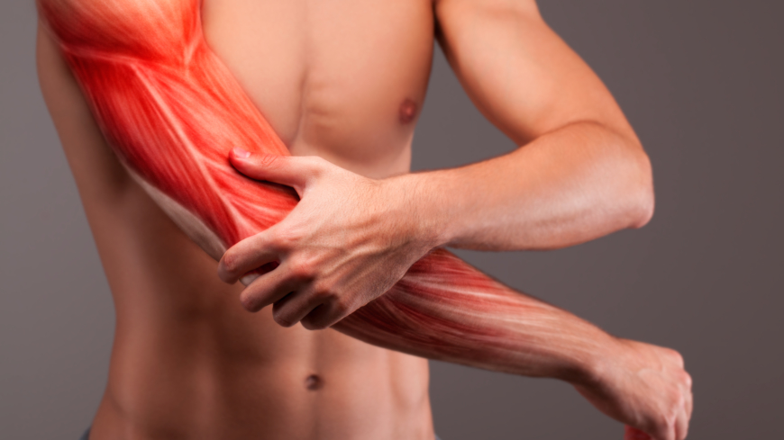 En muskelbristning orsakas av att muskelfibrer går av vilket skapar en blödning i muskelvävnaden. Foto: Shutterstock